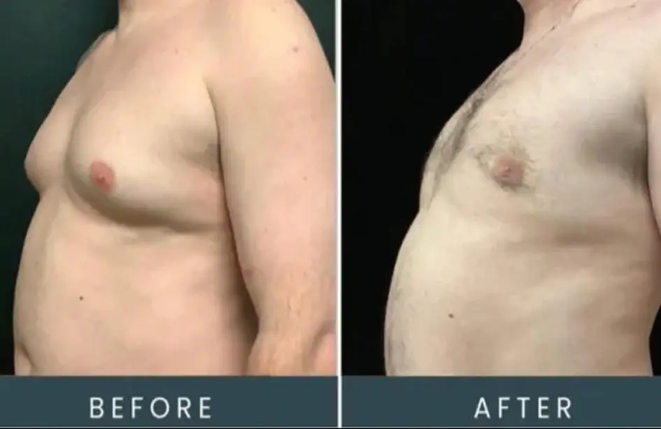Before and after front view of male torso, showing treatment results