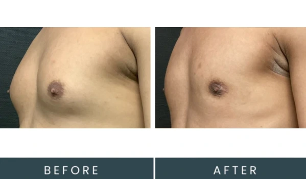 Before and after angled view of male chest showing body contouring results