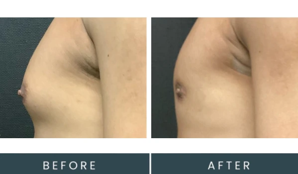 Before and after left side view of male chest showing body contouring results