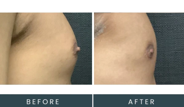 Before and after right side view of male chest, showing treatment results