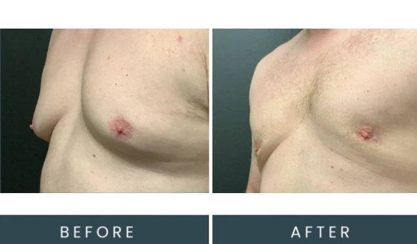 Before and after angled view of male chest showing body contouring results