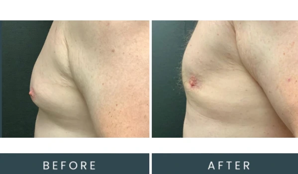 Before and after left side view of male chest showing body contouring results