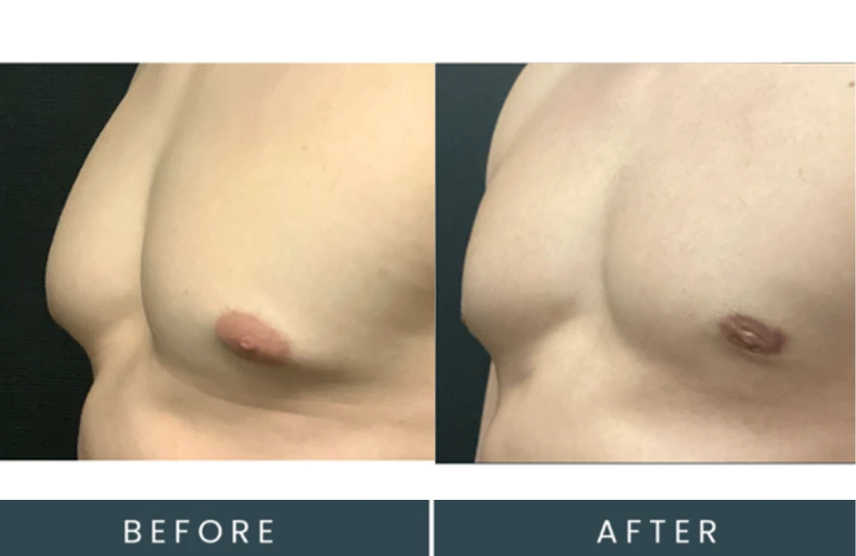 Male chest before and after treatment showing improved contour