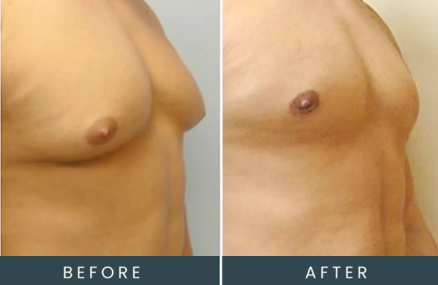 Before and after chest treatment showing reduced gynecomastia