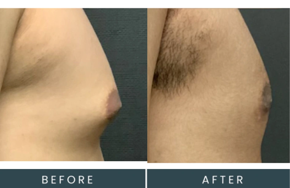 Male torso before and after treatment showing improved chest contour