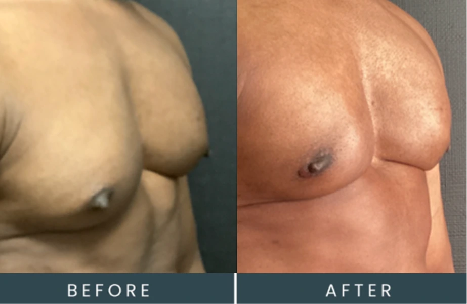 Before and after chest contouring showing improved definition