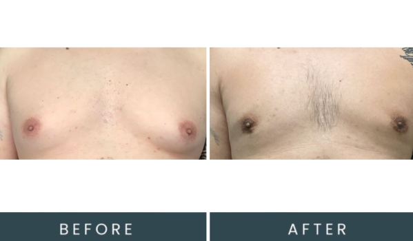 Case 41 front view before and after chest procedure