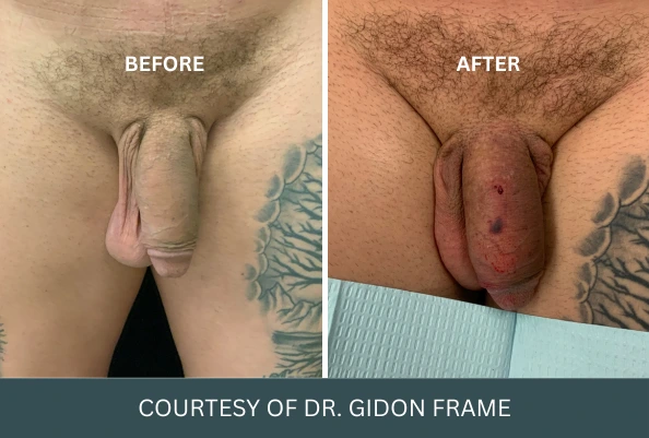 Before and after penile enhancement comparison, courtesy of Dr. Gidon Frame