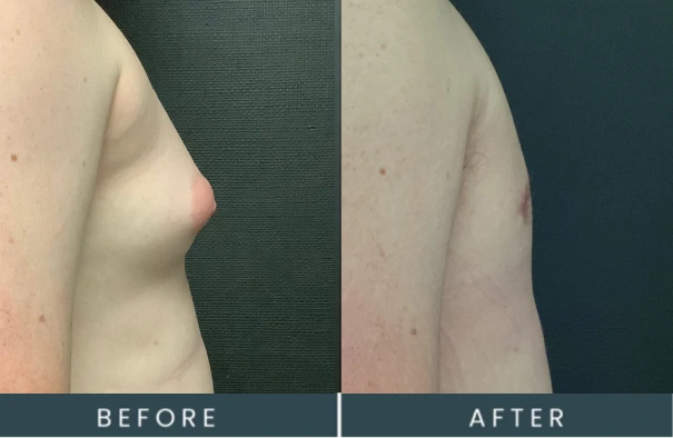 Before and after male chest contouring in Westwood, MA showing improved definition