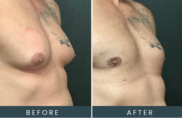 Before and after gynecomastia surgery in Westwood, MA showing a flatter male chest