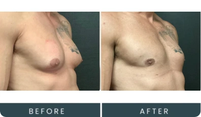 Case 42 angled view before and after male chest procedure at Regeneris Men