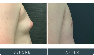 Case 42 left side view before and after male chest procedure at Regeneris Men
