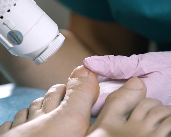 Podiatrist in gloved hand applying laser treatment device to patient's toenail