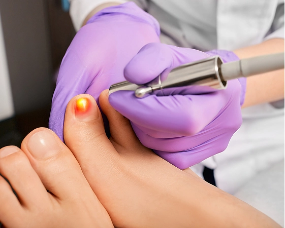 Clinician in purple gloves using laser therapy device on patient's toenail with glowing red beam