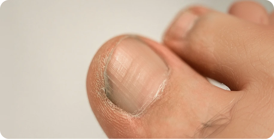 Toenail with fungal infection showing discoloration and lifting from the nail bed