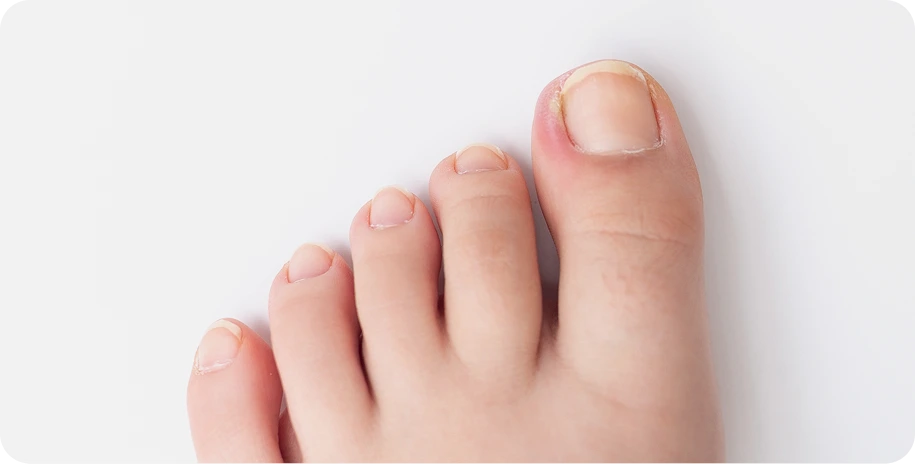 Toes showing toenail lifting and peeling from the nail bed
