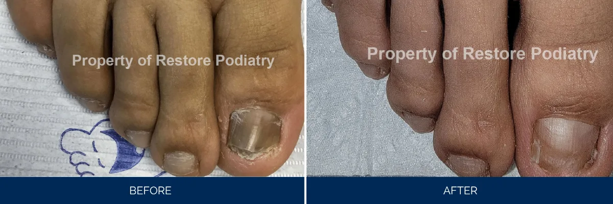 Before and after comparison of toenail fungal treatment at Restore Podiatry
