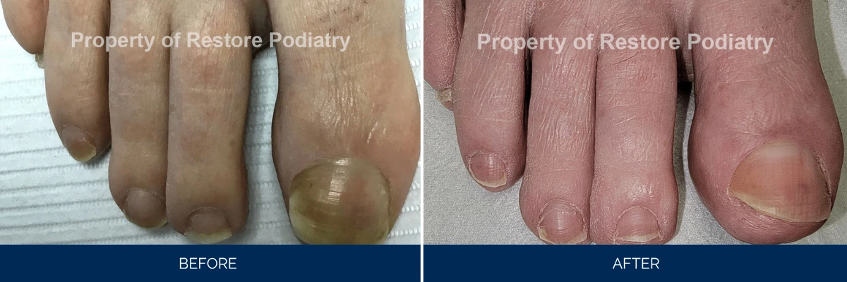 Before and after comparison of foot showing thick, discolored toenail treated at Restore Podiatry