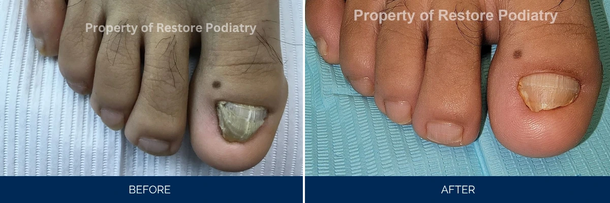 Before and after comparison of foot with fungal toenail infection treated at Restore Podiatry