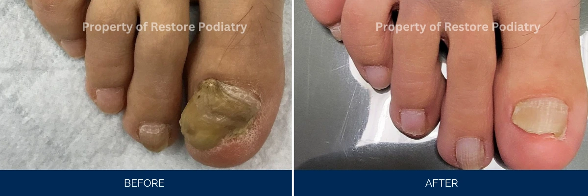 Before and after toenail treatment showing discolored nail becoming clear and healthy