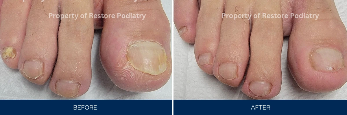 Before and after foot treatment showing toenail with fungal infection resolving to clear nail
