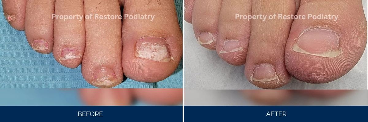 Before and after toenail treatment showing damaged nails becoming smooth and restored