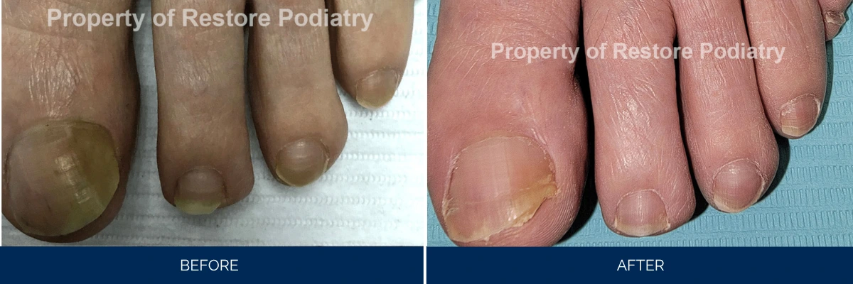 Before and after foot treatment showing darkened toenails becoming pink and healthy