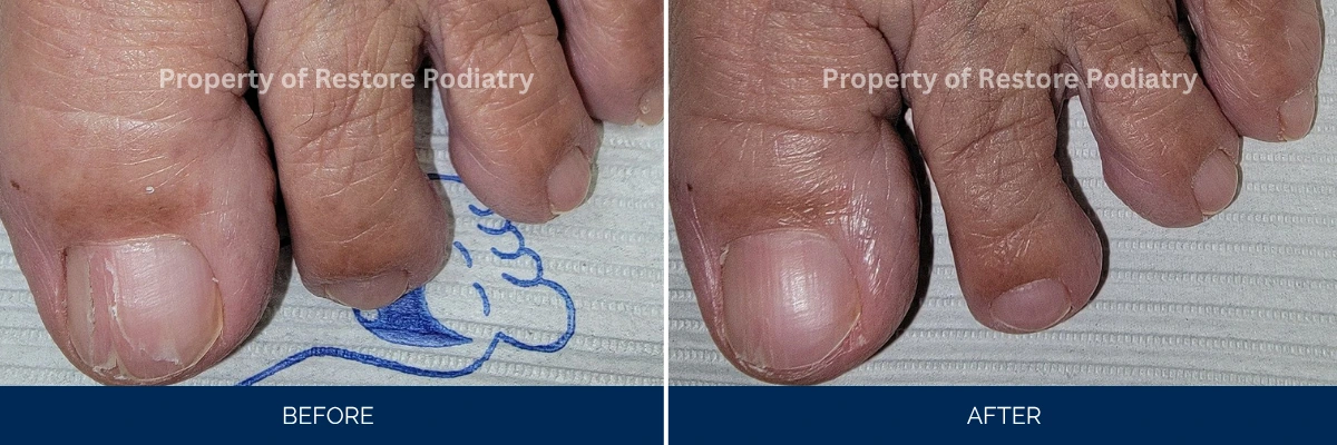 Before and after treatment showing thickened toenails becoming thin and clear