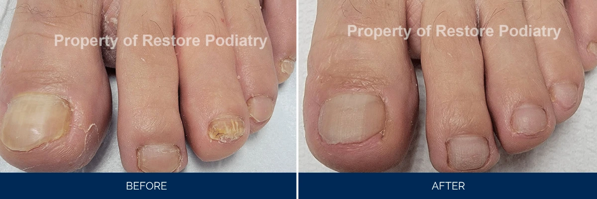 Before and after foot treatment showing discolored toenails becoming clear and uniform