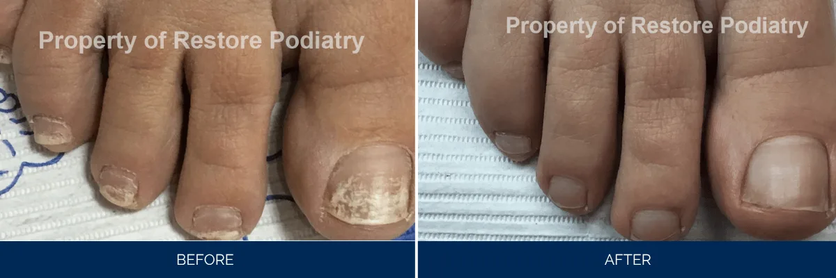 Before and after toenail fungus treatment showing discolored nails transformed to clear healthy nails