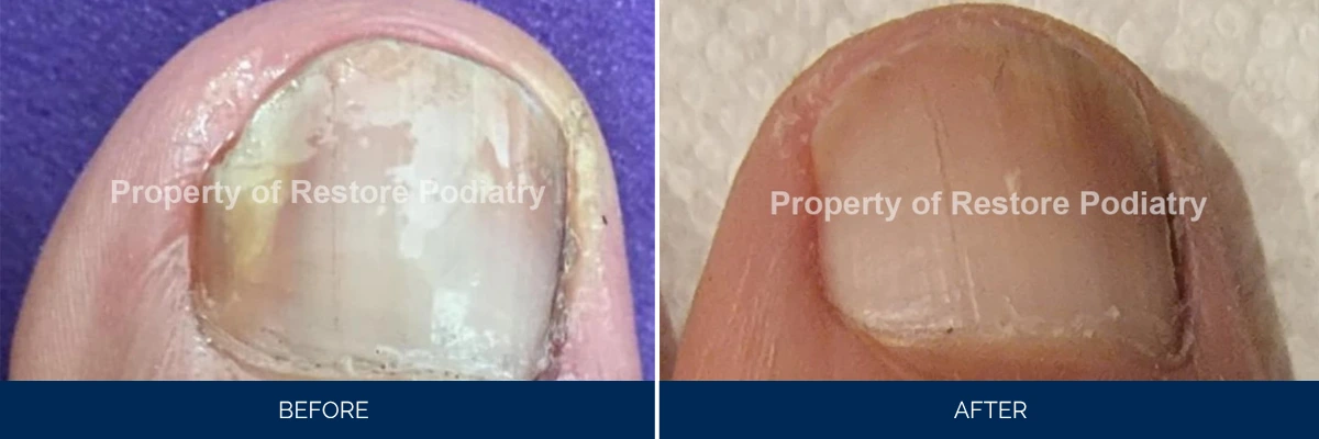 Before and after comparison of toenail fungus treatment at Restore Podiatry