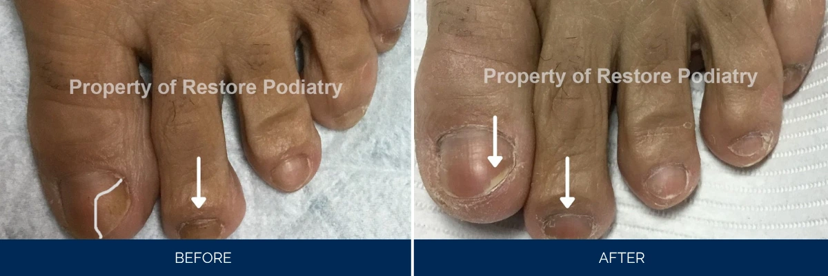 Before and after comparison of ingrown toenail treatment with white arrows indicating affected areas