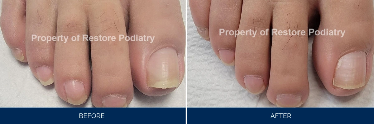 Before and after comparison of toenail fungus treatment on foot toes