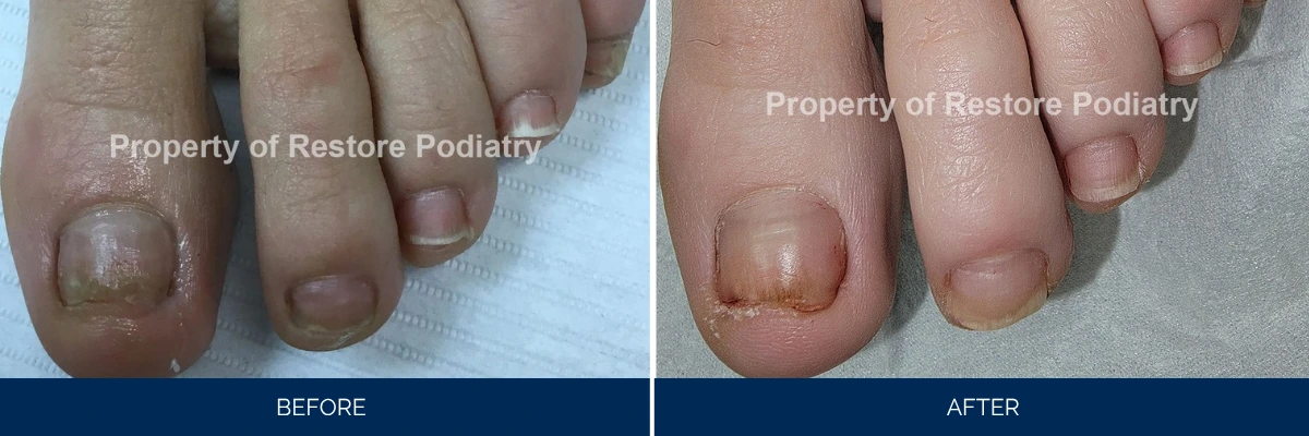 Before and after comparison of toenail fungus treatment on hallux toe