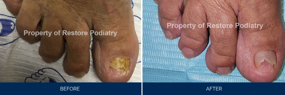 Before and after comparison of severe toenail fungus treatment at Restore Podiatry