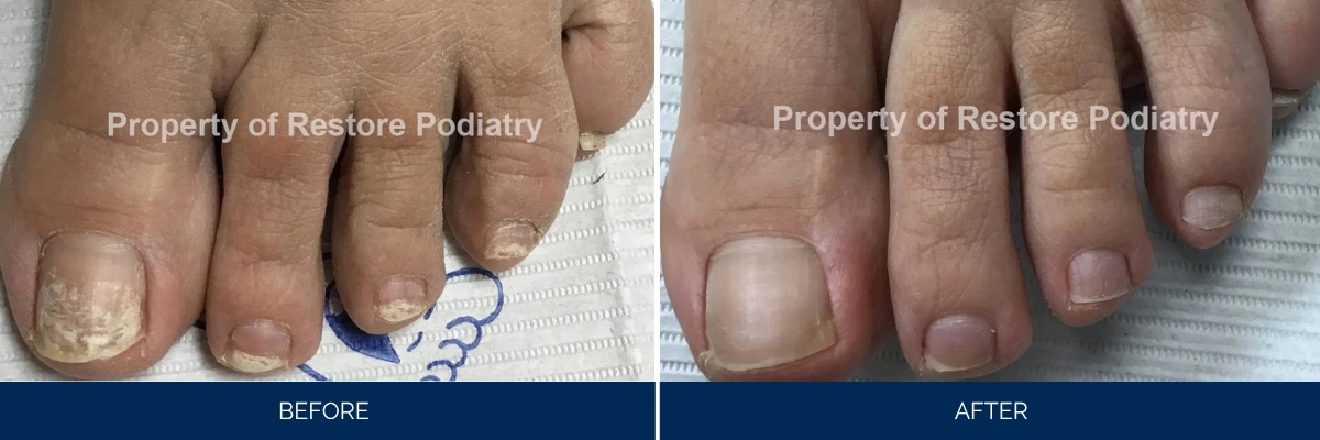 Before and after comparison of toenail fungus treatment on multiple toes