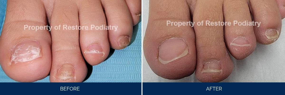 Before and after comparison of toenail fungus treatment, showing diseased nails with white patches progressing to clear healthy nails