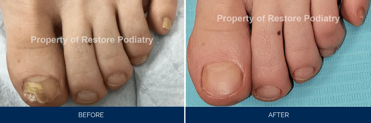 Before and after toenail fungus treatment showing thick yellowed nail restored to normal appearance