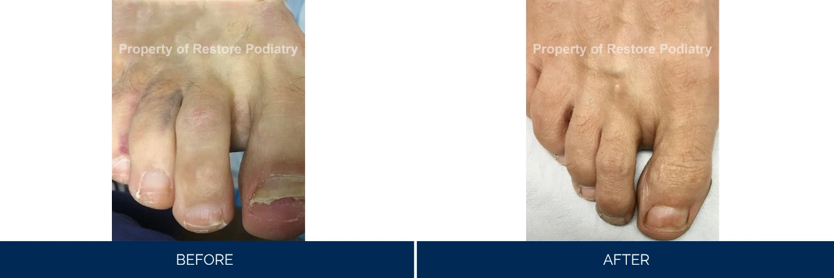 Before and after bunion correction showing swollen toe joint resolved to normal foot alignment