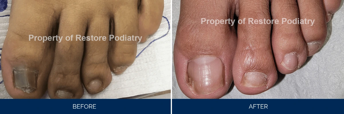 Before and after toenail fungus treatment showing damaged nail bed restored to healthy nail growth