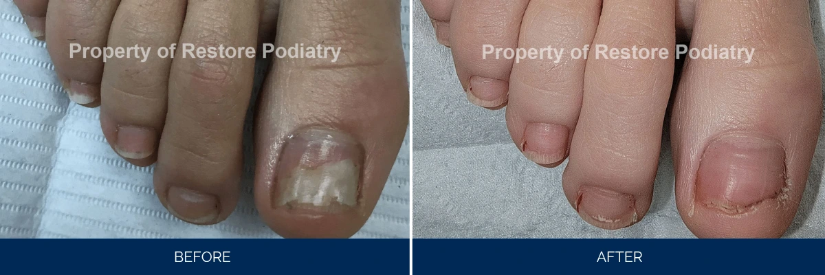 Before and after toenail fungus treatment showing brittle discolored nail cleared and regrown