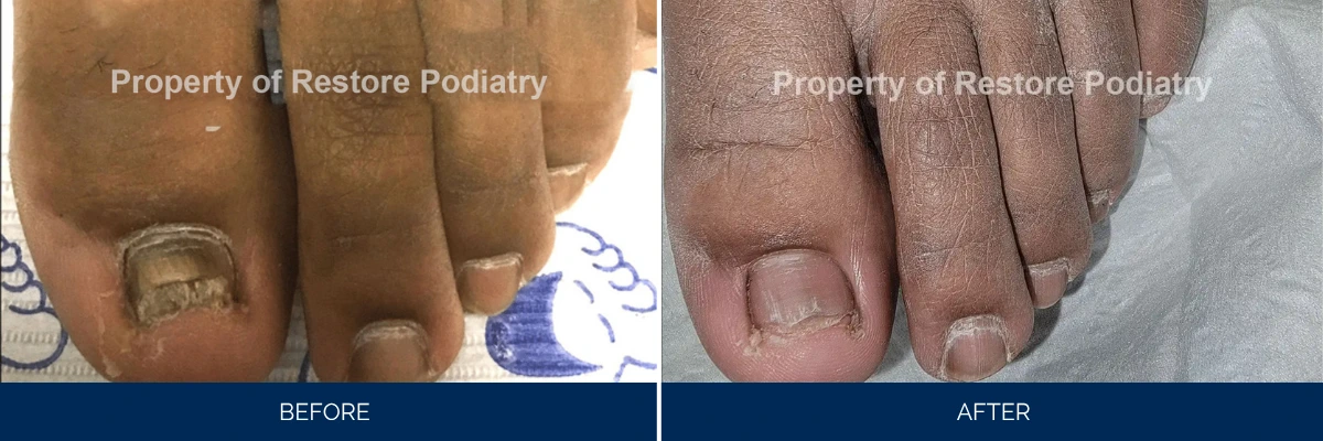 Before and after toenail fungus treatment showing severely infected nail restored to clear appearance