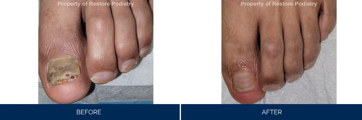 Before and after comparison of toenail with fungal infection and discoloration treated at Restore Podiatry