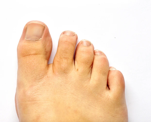 Top view of foot showing blistering and discoloration on the large toe