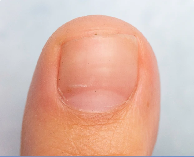 Toenail with fluid-filled blister on nail bed causing nail separation