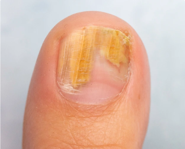 Toenail with yellow discoloration and thick, crumbly appearance indicating fungal infection