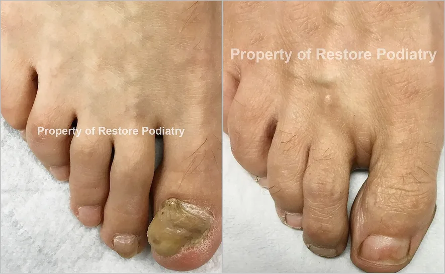 Before and after treatment of toenail fungus on left foot