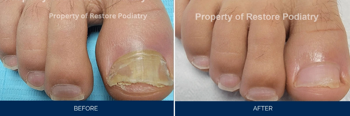 Before and after comparison of toenail fungus treatment, showing discolored nail before and healthy nail after
