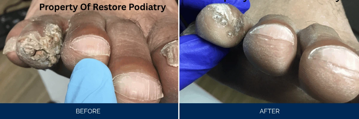 Before and after of fungal nail treatment using blue-gloved instrument, diseased nails with thick white buildup resolved to smooth clear nails