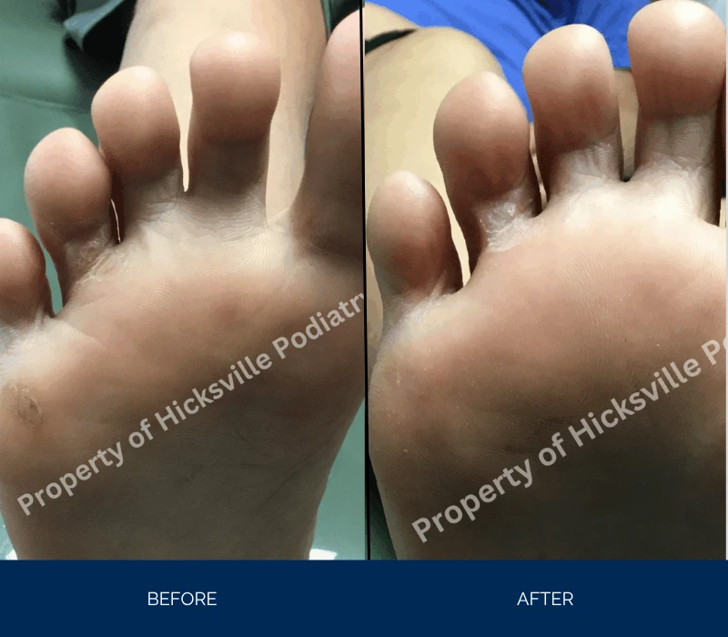 Before and after comparison of foot with wart treatment showing reduced lesion size